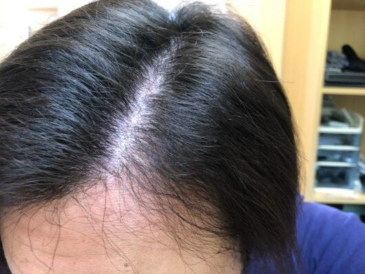 頭皮マッサージを初めて3か月経過しました。全然直毛ではないものの、クセが柔らかくなってきた感があります。