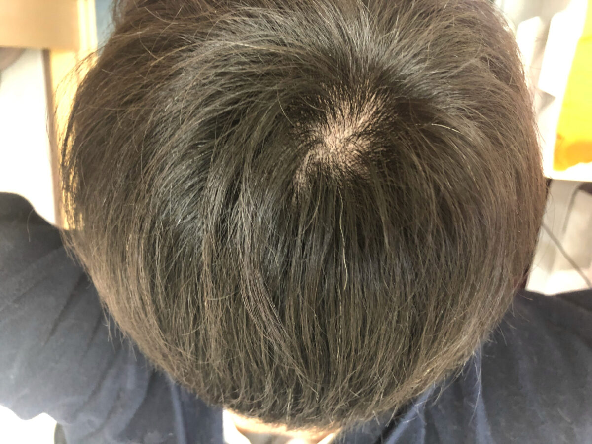 頭皮マッサージでくせ毛を治す検証を始めて１０ヶ月。頭頂部はほとんどウネウネする髪が生えてこなくなりました。白髪も治ってくれたら嬉しいんだが。。。