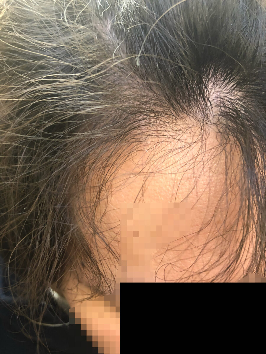 頭皮マッサージでくせ毛を治す検証を始めて１０ヶ月。前髪の生え際付近もゆるいカーブに落ち着いたものの、まだまだウネっている毛が目立ちます。