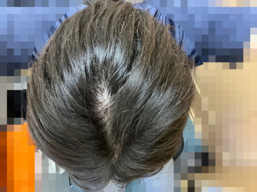頭皮マッサージでくせ毛を治す。長期観察記録20ヵ月の写真です（頭頂部）