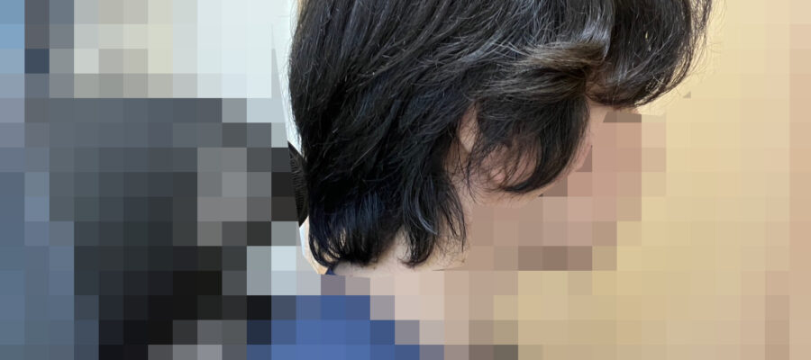 頭皮マッサージでくせ毛を治す。長期観察記録20ヵ月の写真です（サイド１）
