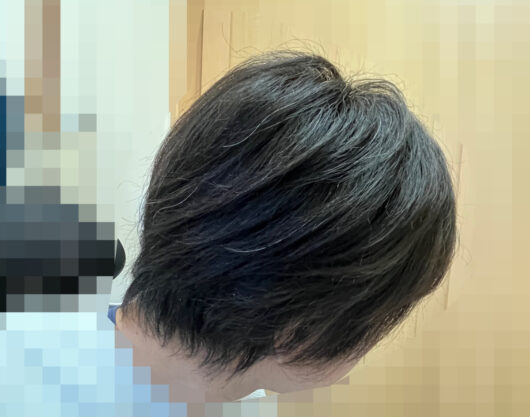 頭皮マッサージでくせ毛を治す。長期観察記録22ヵ月の写真です（後頭部）