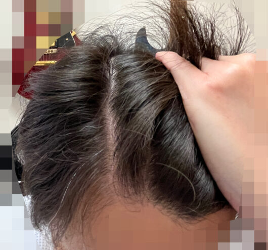 頭皮マッサージでくせ毛を治す。長期観察記録22ヵ月の写真です（生え際部分）