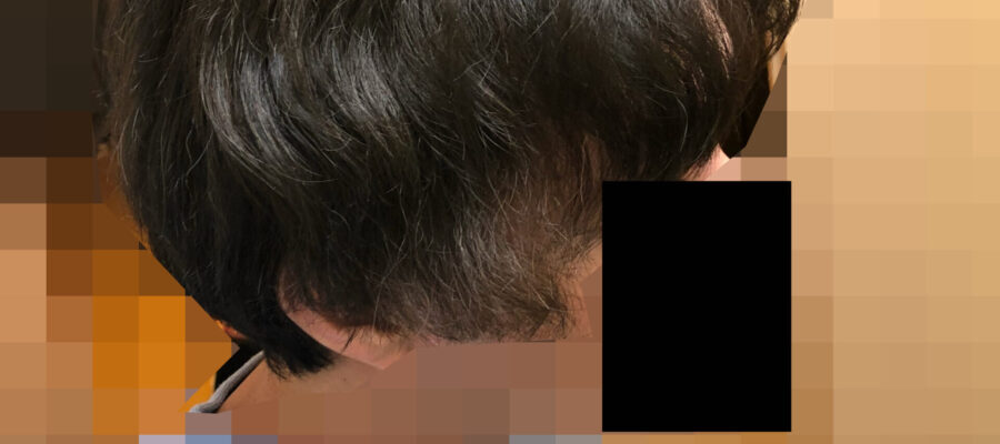 頭皮マッサージの効果検証開始から6か月経過後の写真です。サイドやもみあげあたりはウネウネやチリチリがあります。