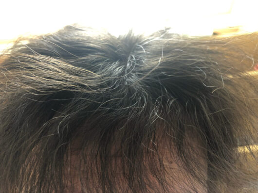 頭皮マッサージの効果検証開始から6か月経過後の写真です。ブローすると落ち着くようにはなりましたが、前髪はまだまだクセがかなり残っています。
