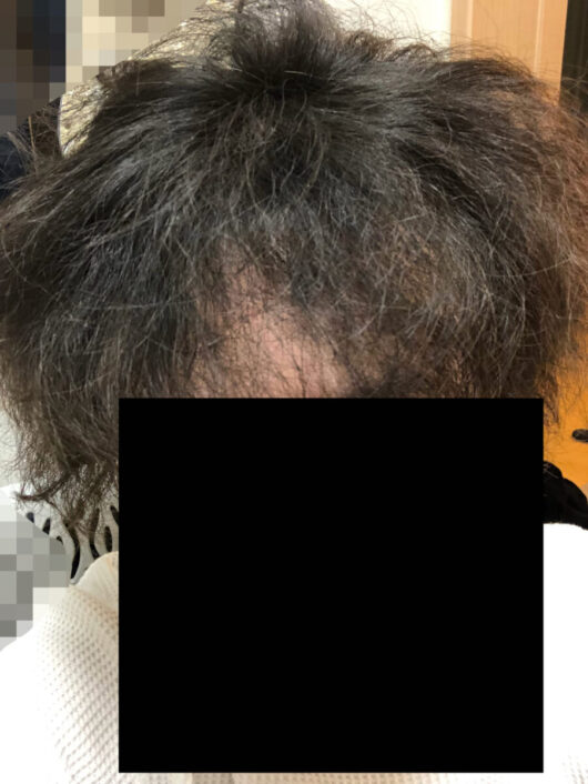 頭皮マッサージの効果検証開始から6か月経過後の写真です。洗髪後適当に乾かしたらこんな感じになっちゃいます。