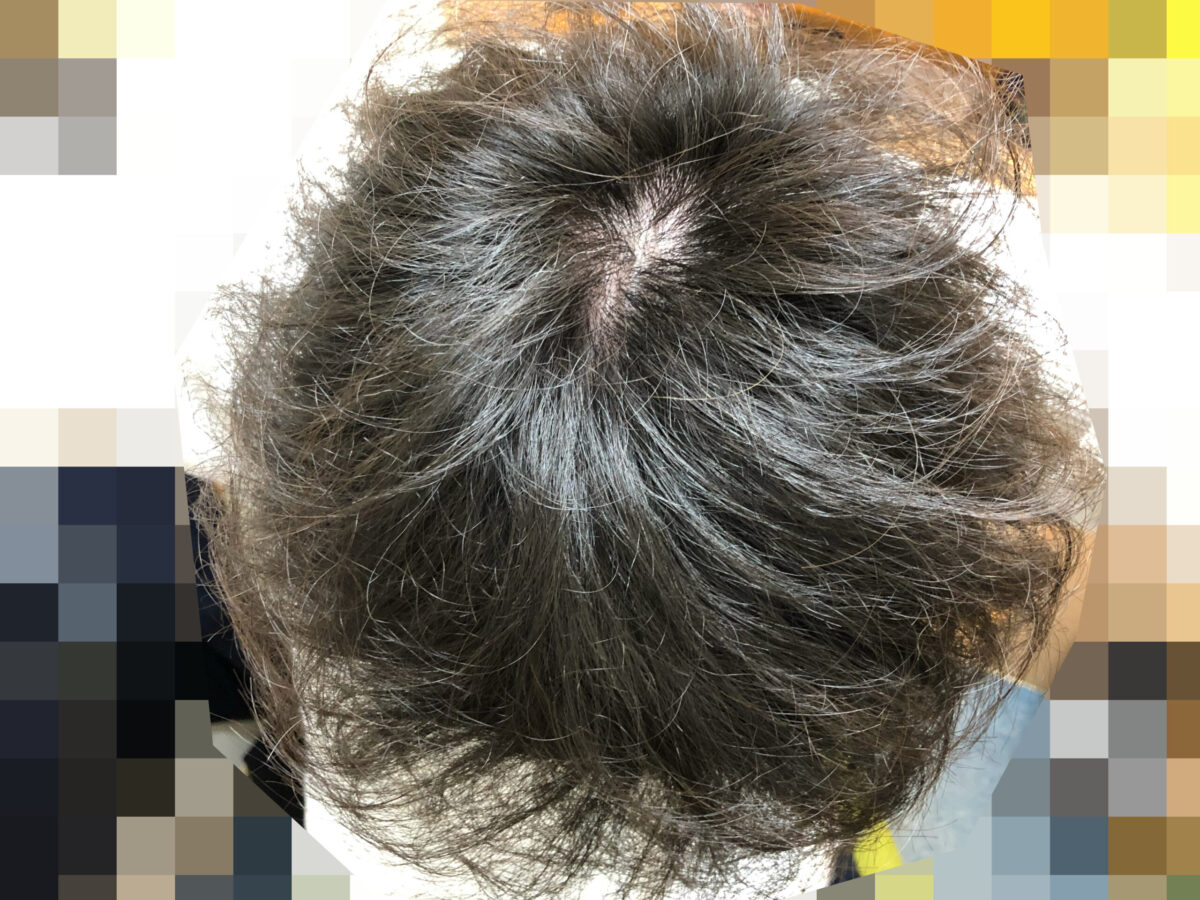 頭皮マッサージの効果検証開始から6か月経過後の写真です。頭頂部はいい感じに髪のツヤが出てきたかも？毛先はホワホワ。