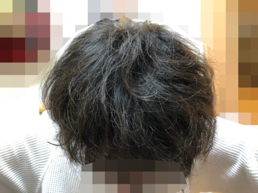 頭皮マッサージの効果検証開始から6か月経過後の写真です。パサパサだった髪にツヤが出てきたような気がします。