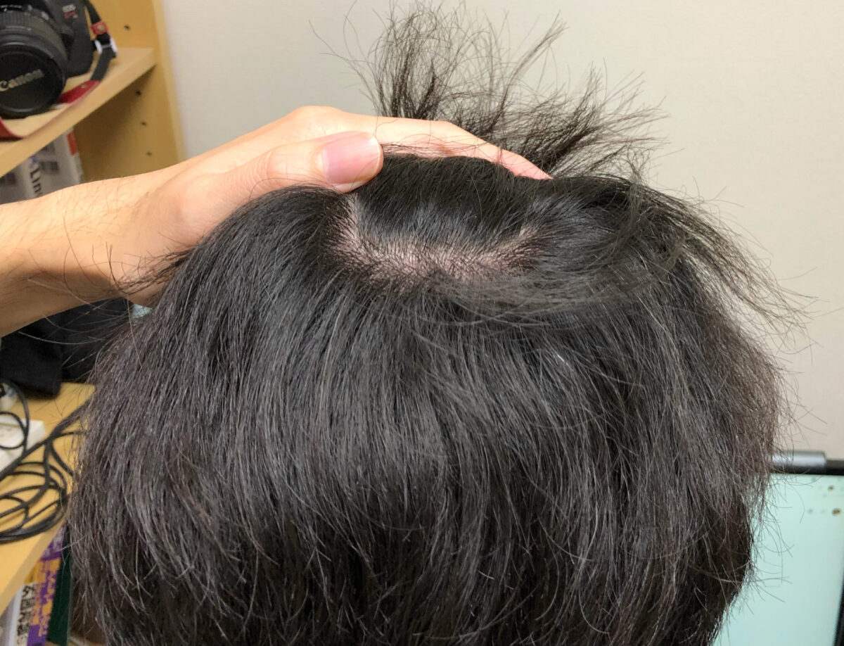 頭皮マッサージの効果検証開始から6か月経過後の写真です。後頭部は特に強いウネリがあって段々が出来てしまう髪質でしたが、かなり落ち着いています。