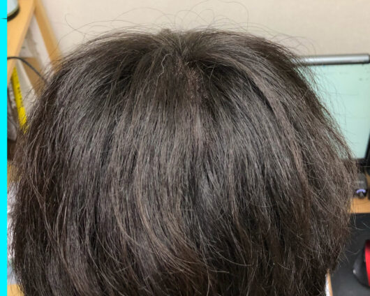 頭皮マッサージの効果検証開始から6か月経過後の写真です。後頭部は特に強いウネリがあって段々が出来てしまう髪質でしたが、かなり落ち着いています。