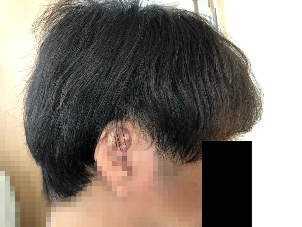 頭皮マッサージを開始してから七ヶ月経過した写真です。サイド部分はまだまだクセが残ってます。